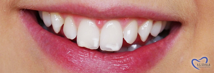 ¿ Qué es la fluorosis dental ?