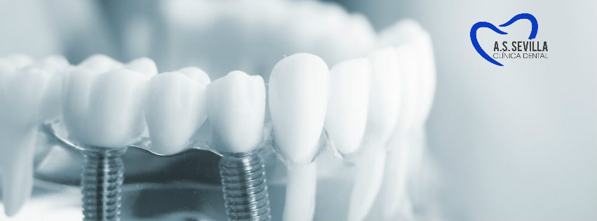 ¿Implantes o puentes dentales?